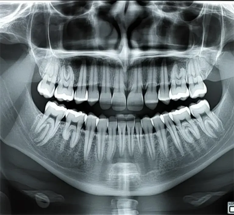 Radiografia panorâmica mostrando os dentes e estruturas ósseas