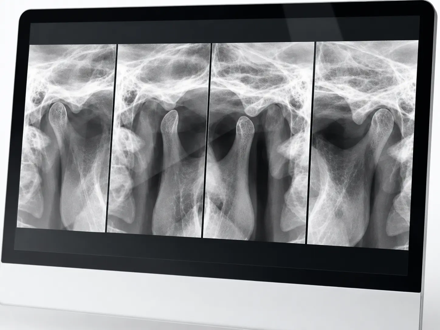 Radiografia de ATM exibida em monitor