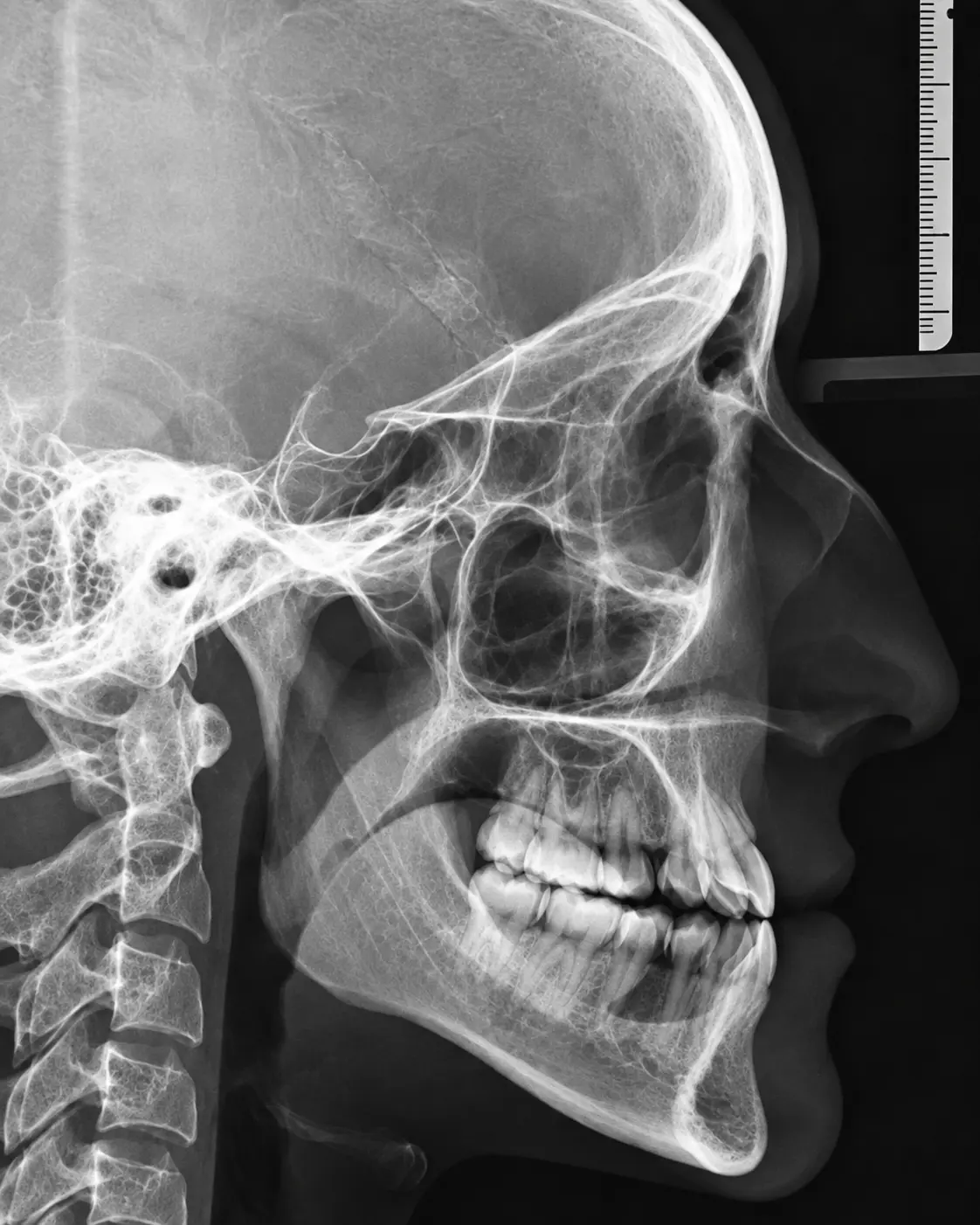 Radiografia cefalométrica lateral do crânio