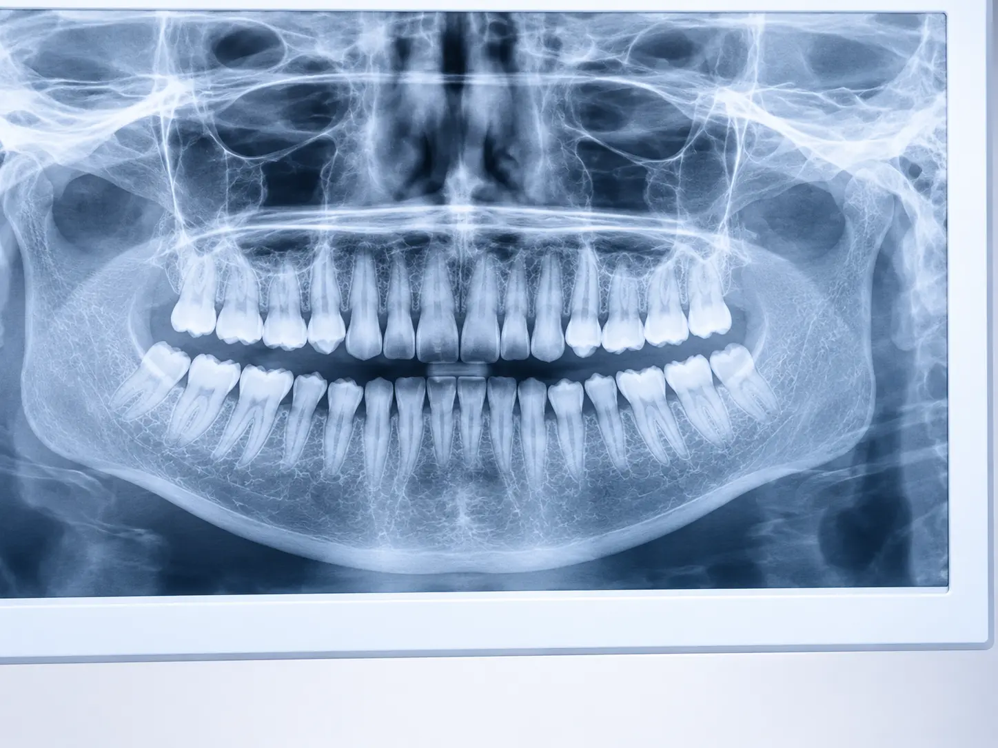 Radiografia panorâmica exibida em um monitor